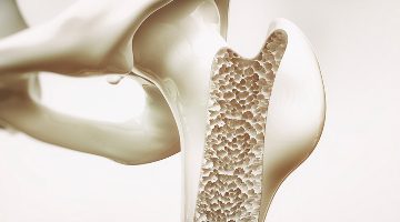 Prevenire l’osteoporosi oggi si può 2 news 28 202002180124 osteoporosi big